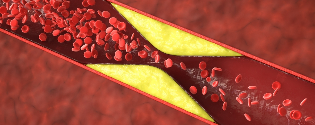 Half of Heart Attacks in Younger Women Aren't From Clogged Arteries : ScienceAlert