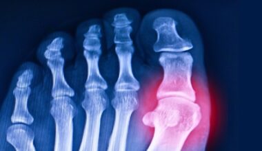 Scientists Revive 20-Million-Year-Old Gene to Help Fight Gout : ScienceAlert