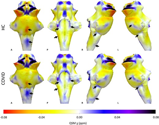 Brainstems mapping differences in healthy and long covid brains