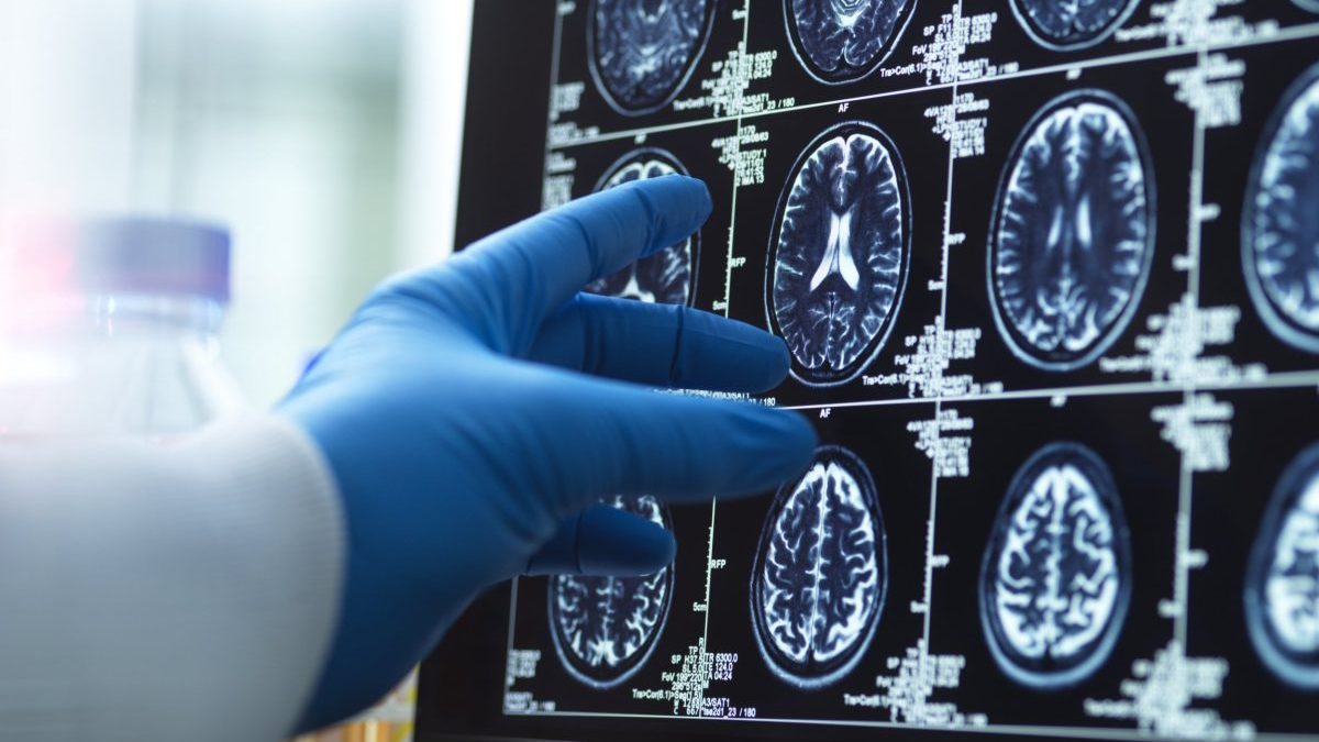 Blood tests for Alzheimer's could be life-changing