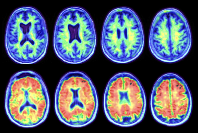 PET scans