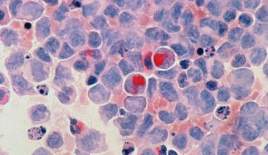 New data sheds light on immunotherapy failure, bringing hope to patients with cancer