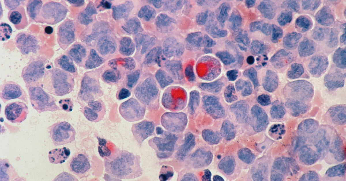 New data sheds light on immunotherapy failure, bringing hope to patients with cancer