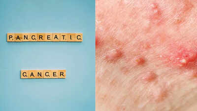 Pancreatic cancer symptoms on skin: Early signs you shouldn’t ignore