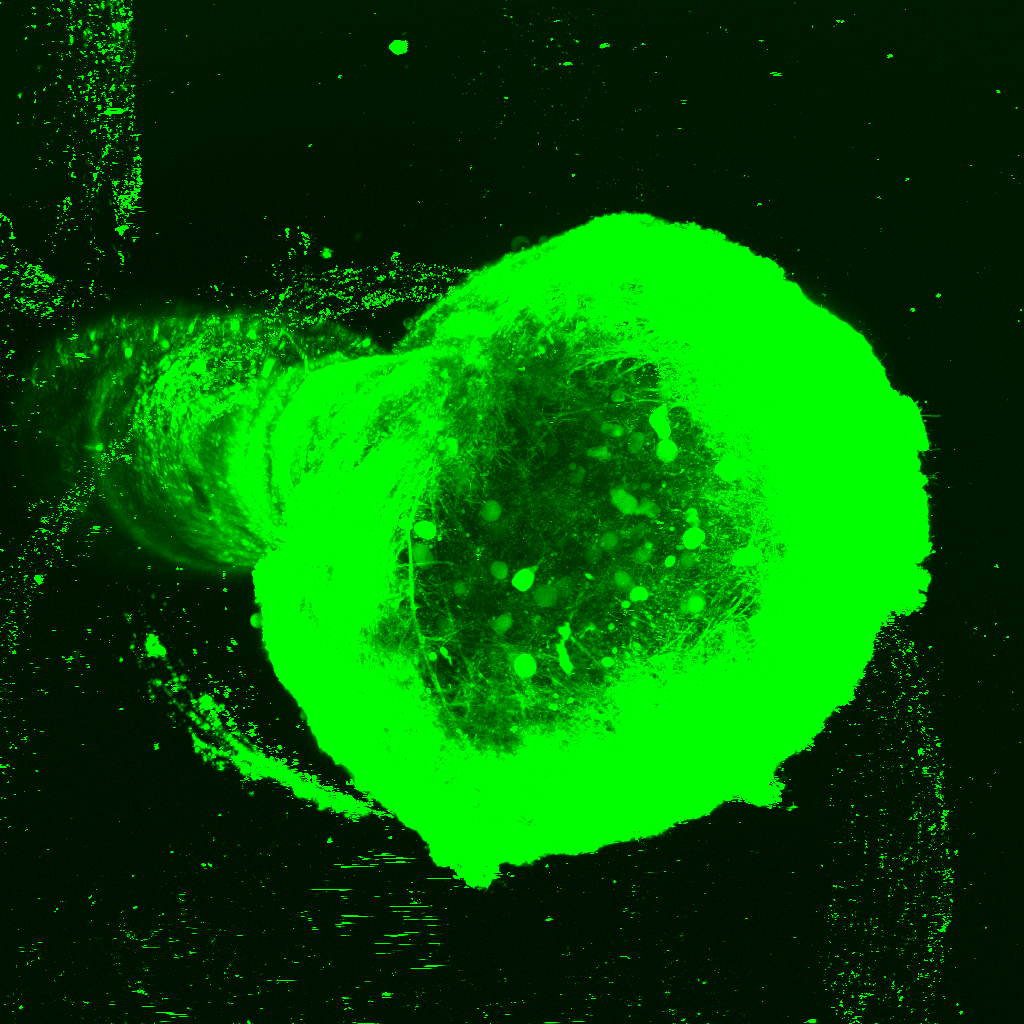 Top-down view of a biohybrid brain implant, showing bright green strands of lab-grown brain cells surrounding a tiny electronic device.