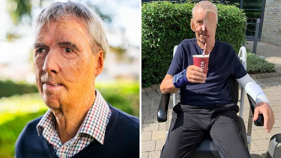 Dave Richards - Cyclist with first 'NHS 3D printed face' - SWNS