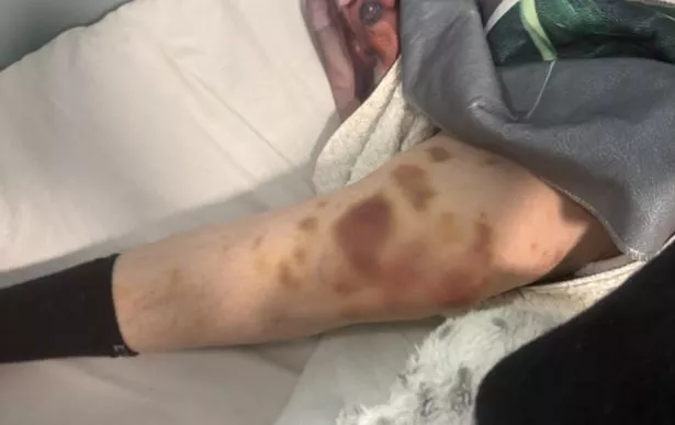 Bruising visible on Marie Metcalf's leg after a fall