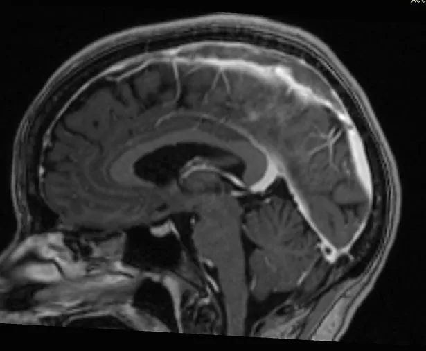 Superior sagittal sinus thrombosisis the most common type of dural venous sinus thrombosis