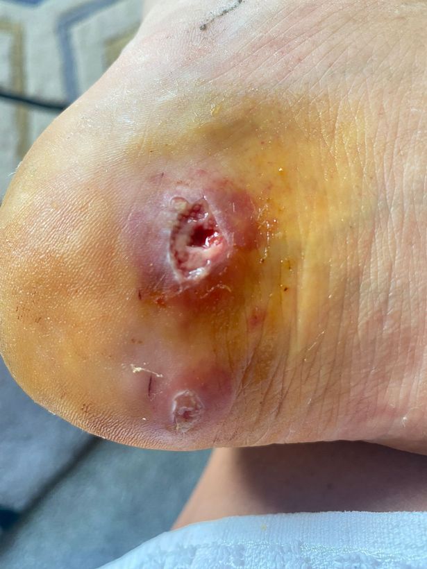 Chloe's infected cat bite.