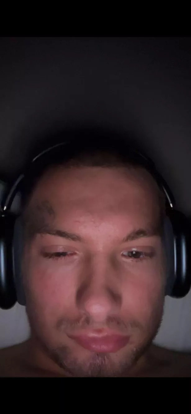 Harvey says his right eye is stuck half closed following the procedures