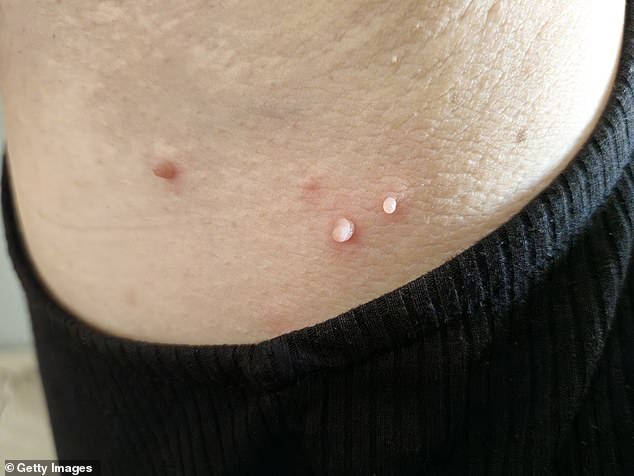 And if you are tempted to remove them at home, there are various skin tag remover kits that are for sale