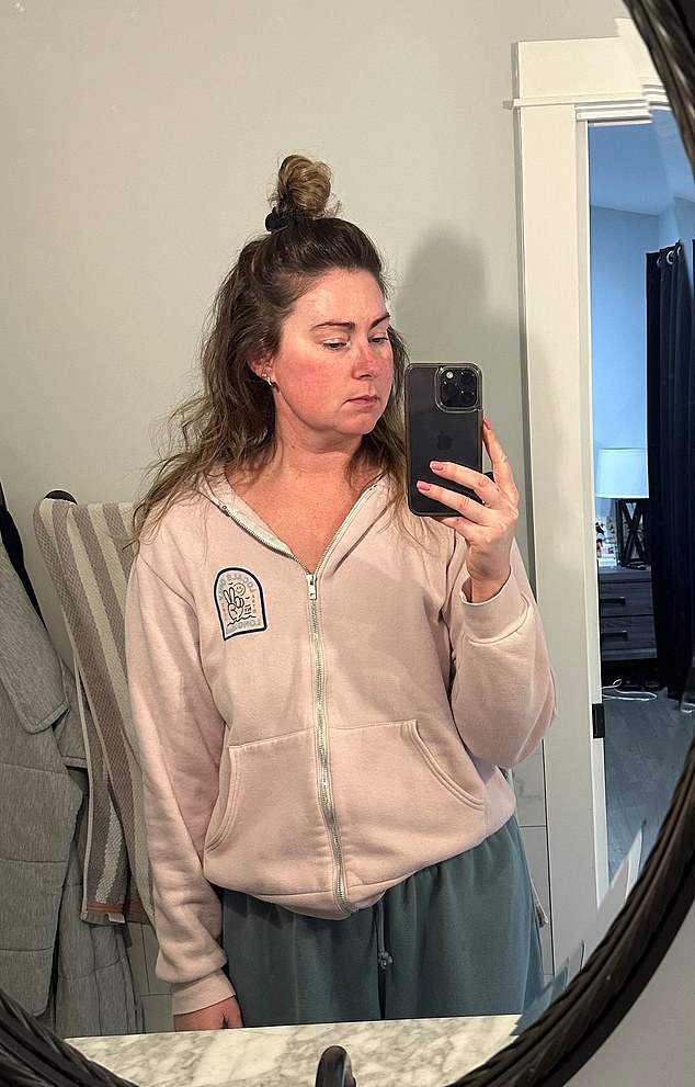 Katelyn Bonacasa,30, suffered from a swollen face acne and her hair falling out