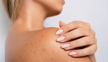 Excess sweating raises the risk of bacne so it’s important that people regularly shower after sweating as well as wear loose, breathable clothing