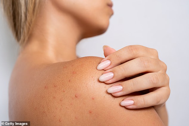 Excess sweating raises the risk of bacne so it’s important that people regularly shower after sweating as well as wear loose, breathable clothing