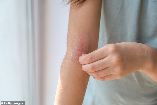 Many people suffer with itchy skin in colder weather.
