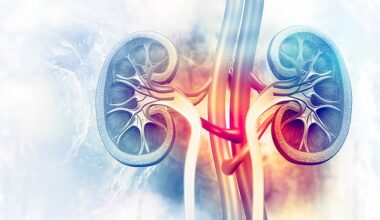 Kidney stones are hard objects made of minerals and salts in urine