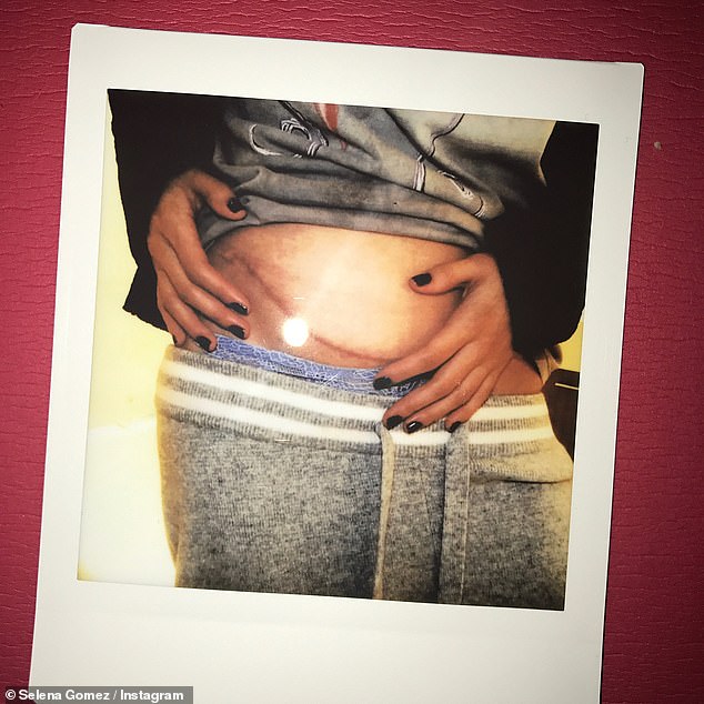 Raisa and Gomez previously revealed their scars from the donation procedure. Gomez also has one on the inside of her thigh from emergency surgery to save her life after one of her arteries burst during the procedure