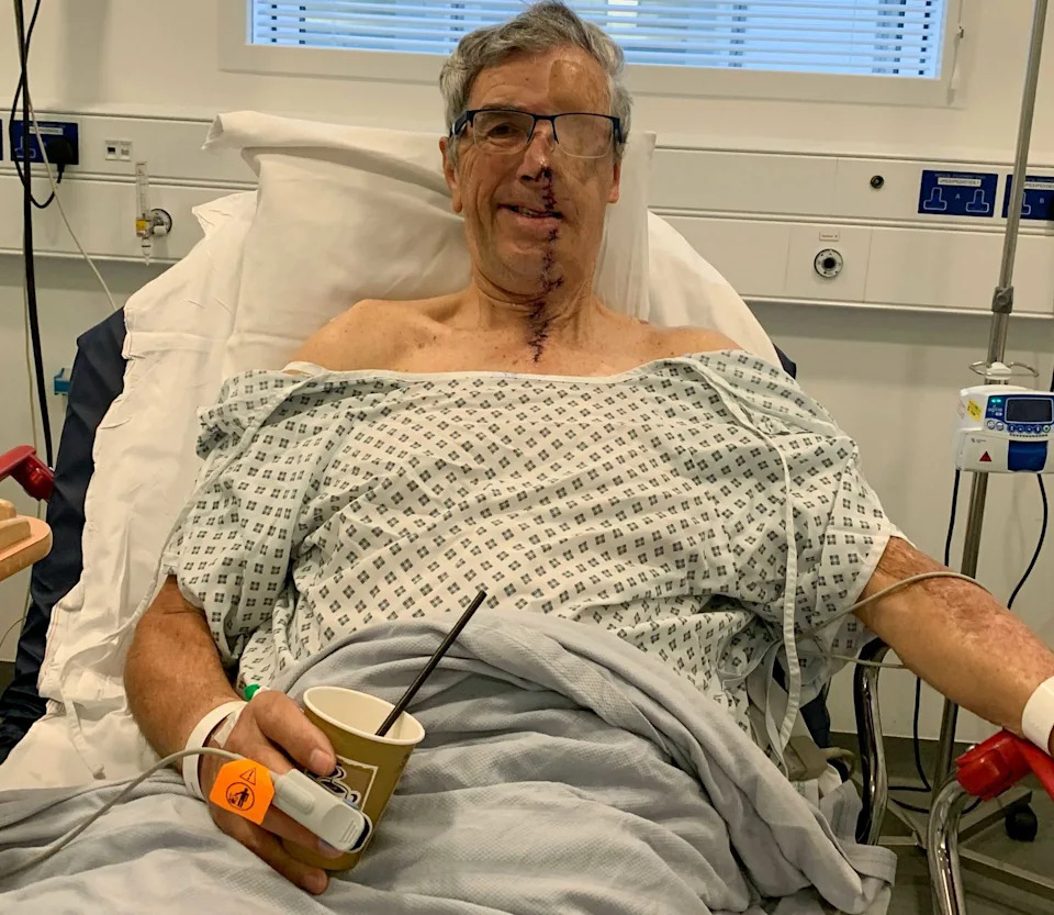 Dave Richards - Man with first 'NHS 3D printed face' - SWNS