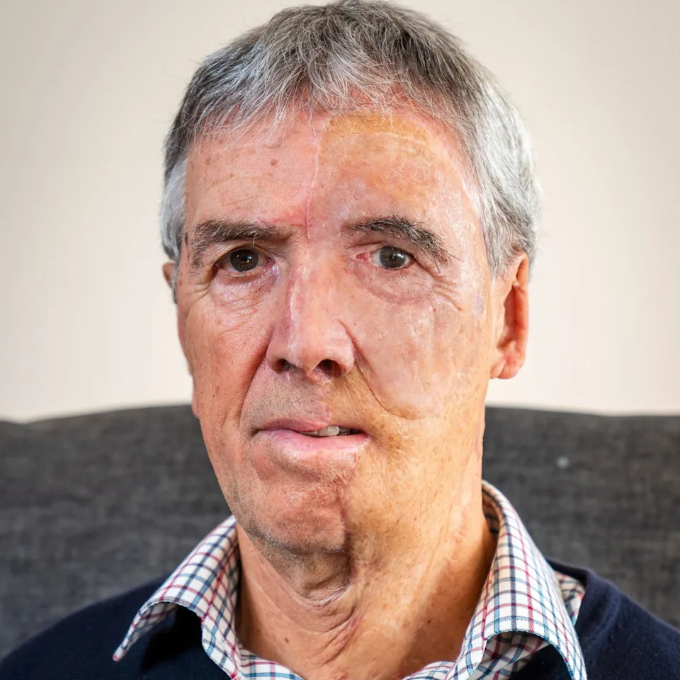 Dave Richards - Man with first 'NHS 3D printed face' - SWNS