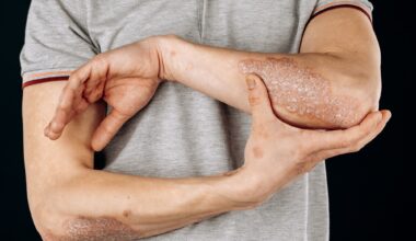 Study: Causal Relationships Between Popular Diets (Low-Calorie, Vegetarian, and Gluten-Free Diets) and Inflammatory Skin Diseases: A Mendelian Randomization Study. Image Credit: Fuss Sergey / Shuttertock