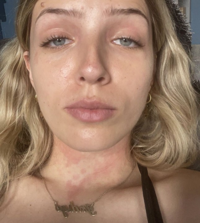 PIC FROM Kennedy News and Media (PICTURED: INDIGO DUFFY, 22, WHO CAUGHT SCARLET FEVER) A woman who thought she caught the flu at a gig was left 'panicking' to learn she had actually contracted a 'Victorian disease' that 'wiped out' families. Indigo Duffy began developing what she thought was a sore throat after attending a 'really hot and packed' gig in a Brixton pub. The 22-year-old assumed the symptom was the start of a flu or cold as she had also been to music festival the week before. DISCLAIMER: While Kennedy News and Media uses its best endeavours to establish the copyright and authenticity of all pictures supplied, it accepts no liability for any damage, loss or legal action caused by the use of images supplied and the publication of images is solely at your discretion. SEE KENNEDY NEWS COPY - 0161 697 4266