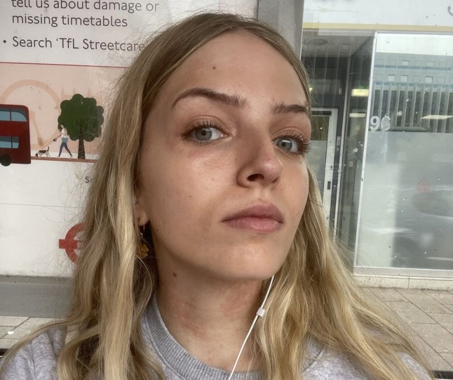 PIC FROM Kennedy News and Media (PICTURED: INDIGO DUFFY, 22, WHO CAUGHT SCARLET FEVER) A woman who thought she caught the flu at a gig was left 'panicking' to learn she had actually contracted a 'Victorian disease' that 'wiped out' families. Indigo Duffy began developing what she thought was a sore throat after attending a 'really hot and packed' gig in a Brixton pub. The 22-year-old assumed the symptom was the start of a flu or cold as she had also been to music festival the week before. DISCLAIMER: While Kennedy News and Media uses its best endeavours to establish the copyright and authenticity of all pictures supplied, it accepts no liability for any damage, loss or legal action caused by the use of images supplied and the publication of images is solely at your discretion. SEE KENNEDY NEWS COPY - 0161 697 4266