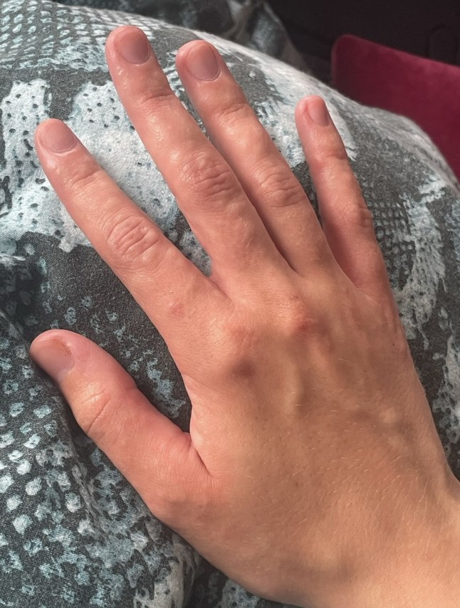 PIC FROM Kennedy News and Media (PICTURED: THE RASH INDIGO DUFFY HAD FROM SCARLET FEVER) A woman who thought she caught the flu at a gig was left 'panicking' to learn she had actually contracted a 'Victorian disease' that 'wiped out' families. Indigo Duffy began developing what she thought was a sore throat after attending a 'really hot and packed' gig in a Brixton pub. The 22-year-old assumed the symptom was the start of a flu or cold as she had also been to music festival the week before. DISCLAIMER: While Kennedy News and Media uses its best endeavours to establish the copyright and authenticity of all pictures supplied, it accepts no liability for any damage, loss or legal action caused by the use of images supplied and the publication of images is solely at your discretion. SEE KENNEDY NEWS COPY - 0161 697 4266