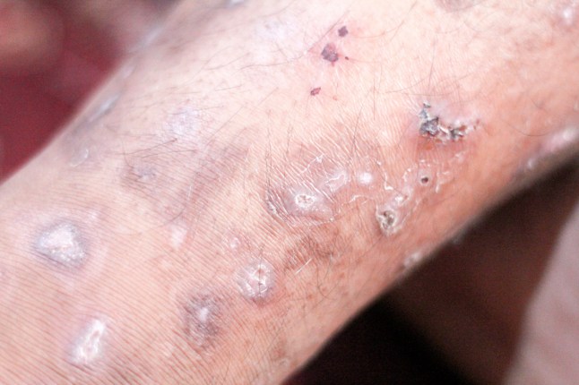 scabies at the foot of a teenage boy; Shutterstock ID 1415146211; purchase_order: -; job: -; client: -; other:
