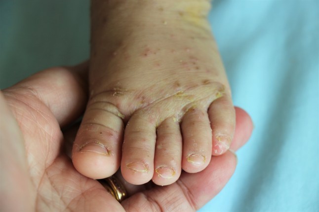 A baby foot was hold showed lesions Erythematous, excoriated papules are present on the foot as scabies. The rashes are itchy small, vesicular, redness, dry scaly on dorsal foot and webs of the toes; Shutterstock ID 1078014848; purchase_order: -; job: -; client: -; other: