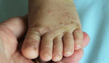 Medieval skin disease leaving patients’ flesh ‘crawling’ surges through the UK | News UK