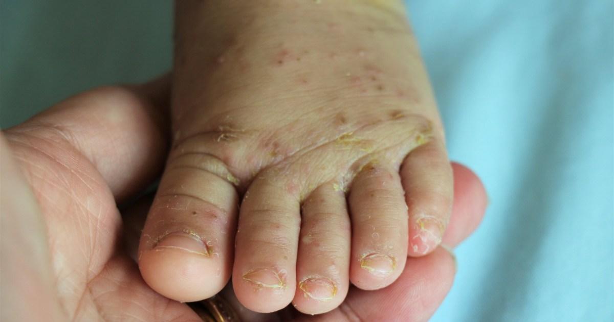 Medieval skin disease leaving patients’ flesh ‘crawling’ surges through the UK | News UK