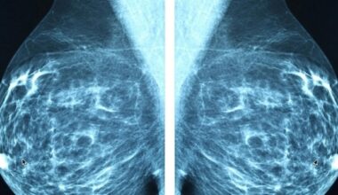 Genetic risk score can help identify women at higher risk of invasive breast cancer