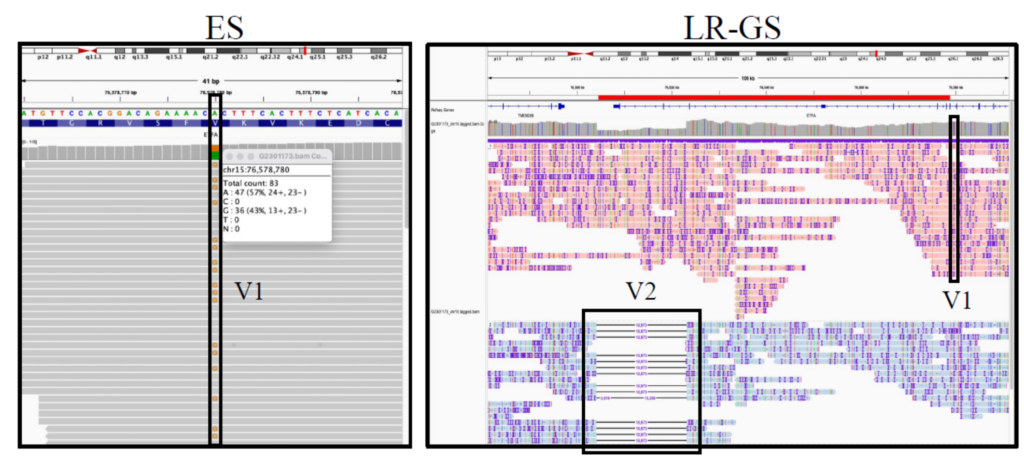 Long Read Whole Genome Sequencing technology can read much longer sequences, enabling it to detect complex mutations better than Short Read Sequencing.
เทคโนโลยี Long Read Whole Genome Sequencing สามารถอ่านลำดับเบสได้ยาวกว่าเดิมมาก ทำให้สามารถตรวจจับการกลายพันธุ์ที่ซับซ้อนได้ดีกว่า Short Read Sequencing