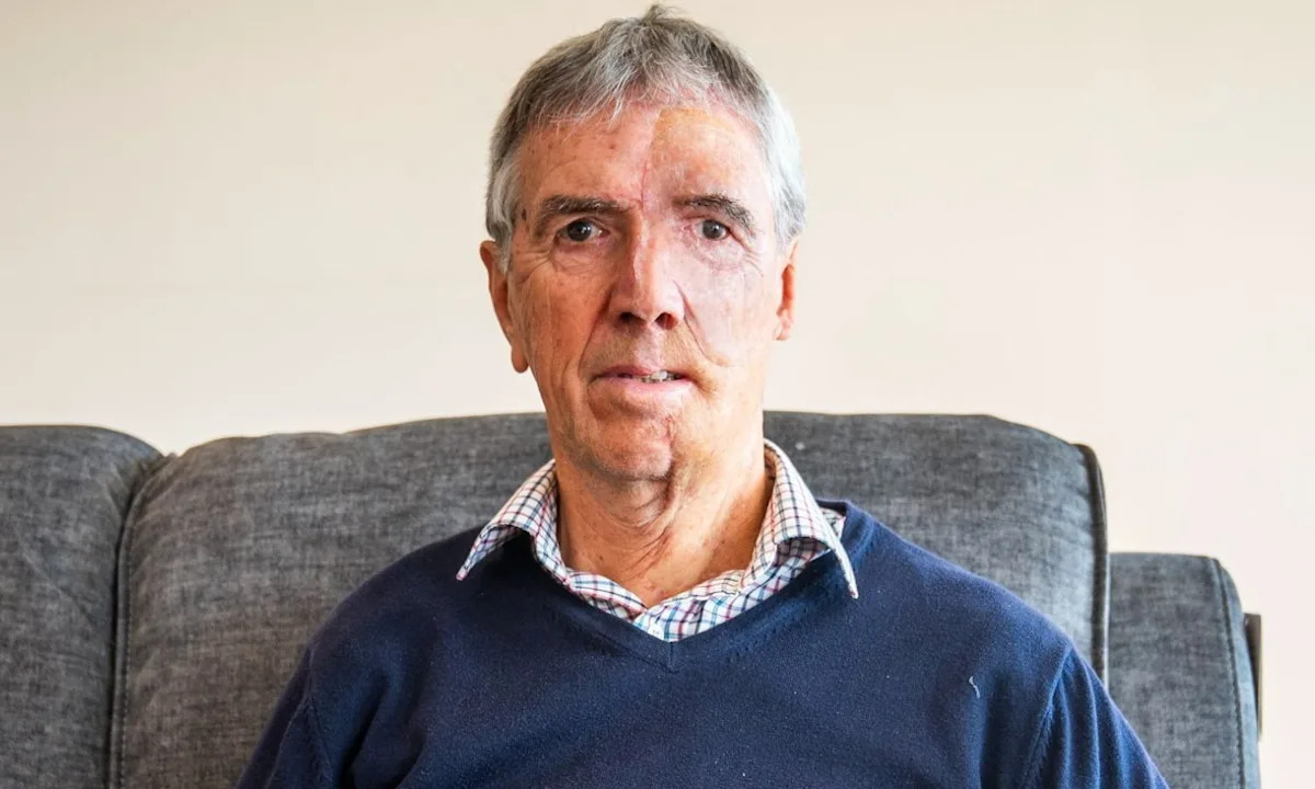 Amazing photos show man's 3D printed face after groundbreaking NHS surgery