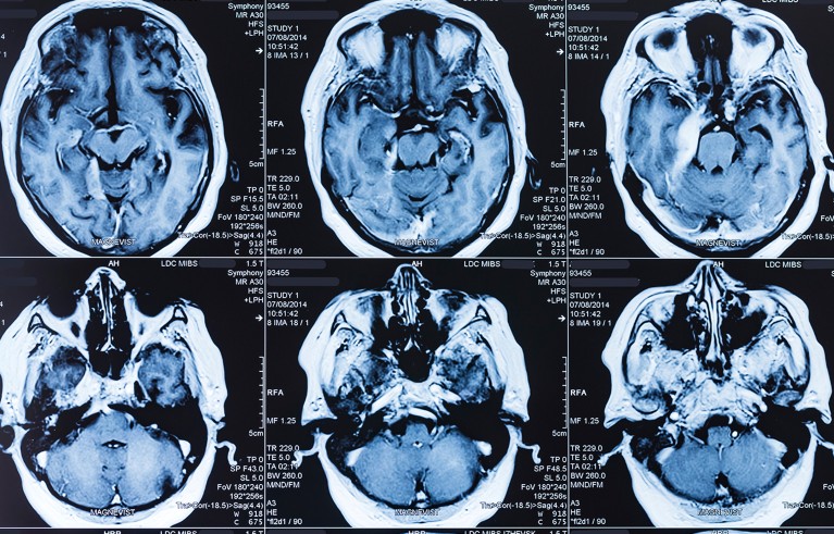 Two rows of MRI brain scans tinted blue.