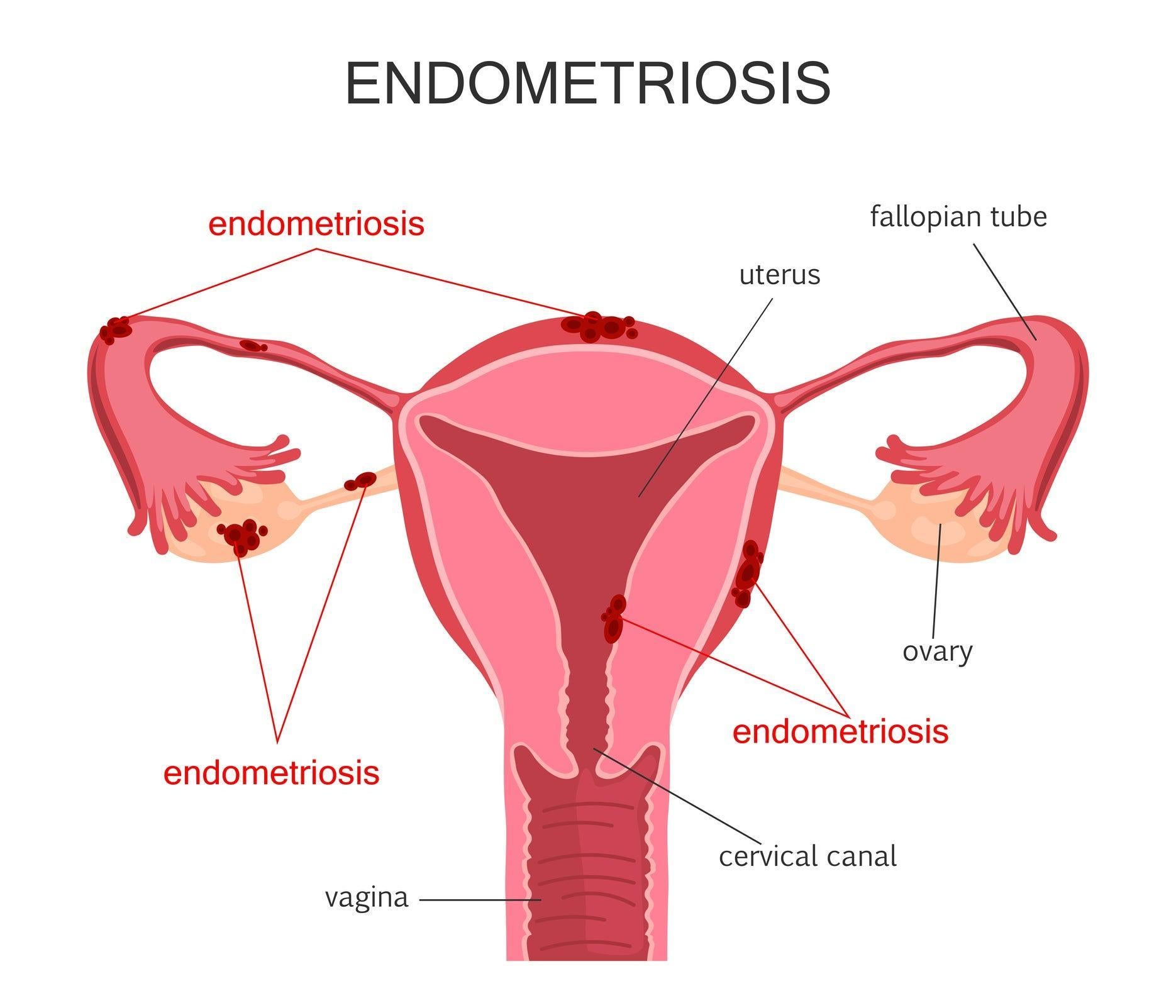 This diagram shows how cysts can be caused by endometriosis