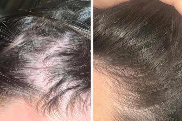 A before and after using Dr Vegan's Hair Saviour tablets with thinning hair on the left and a fuller head of hair on the right