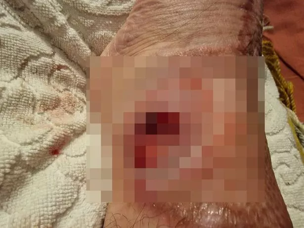 PIXELATED
PIC FROM Kennedy News and Media (PICTURED: ANNIE'S BURNS ON HER ANKLE) A holidaymaker's dream trip to Sardinia turned to horror when she had an epileptic seizure in a hot shower - suffering such severe burns she couldn't walk for 18 MONTHS. Annie Perez, who was diagnosed with epilepsy at 15, jetted off to Sardinia, Italy, to see a band with her friends. After enjoying a leisurely breakfast on their villa balcony, the 38-year-old went for a shower and suffered a seizure while in the bathtub, sustaining severe burns on her right arm and both legs. DISCLAIMER: While Kennedy News and Media uses its best endeavours to establish the copyright and authenticity of all pictures supplied, it accepts no liability for any damage, loss or legal action caused by the use of images supplied and the publication of images is solely at your discretion. SEE KENNEDY NEWS COPY - 0161 697 4266