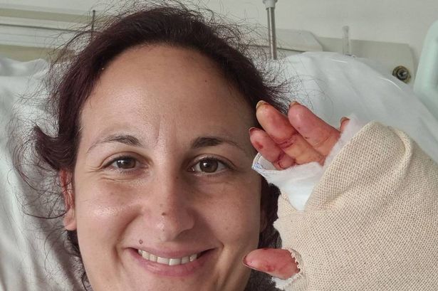 PIC FROM Kennedy News and Media (PICTURED: ANNIE PEREZ, 38, IN HOSPITAL) A holidaymaker's dream trip to Sardinia turned to horror when she had an epileptic seizure in a hot shower - suffering such severe burns she couldn't walk for 18 MONTHS. Annie Perez, who was diagnosed with epilepsy at 15, jetted off to Sardinia, Italy, to see a band with her friends. After enjoying a leisurely breakfast on their villa balcony, the 38-year-old went for a shower and suffered a seizure while in the bathtub, sustaining severe burns on her right arm and both legs. DISCLAIMER: While Kennedy News and Media uses its best endeavours to establish the copyright and authenticity of all pictures supplied, it accepts no liability for any damage, loss or legal action caused by the use of images supplied and the publication of images is solely at your discretion. SEE KENNEDY NEWS COPY - 0161 697 4266