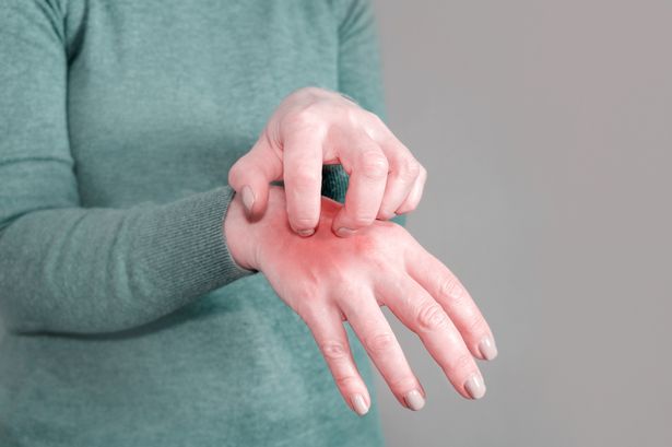 File image of person scratching their hand