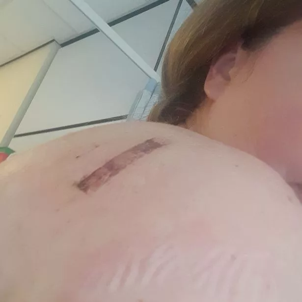 Natalie's shoulder was so damaged that doctors thought she "had been in a car accident"