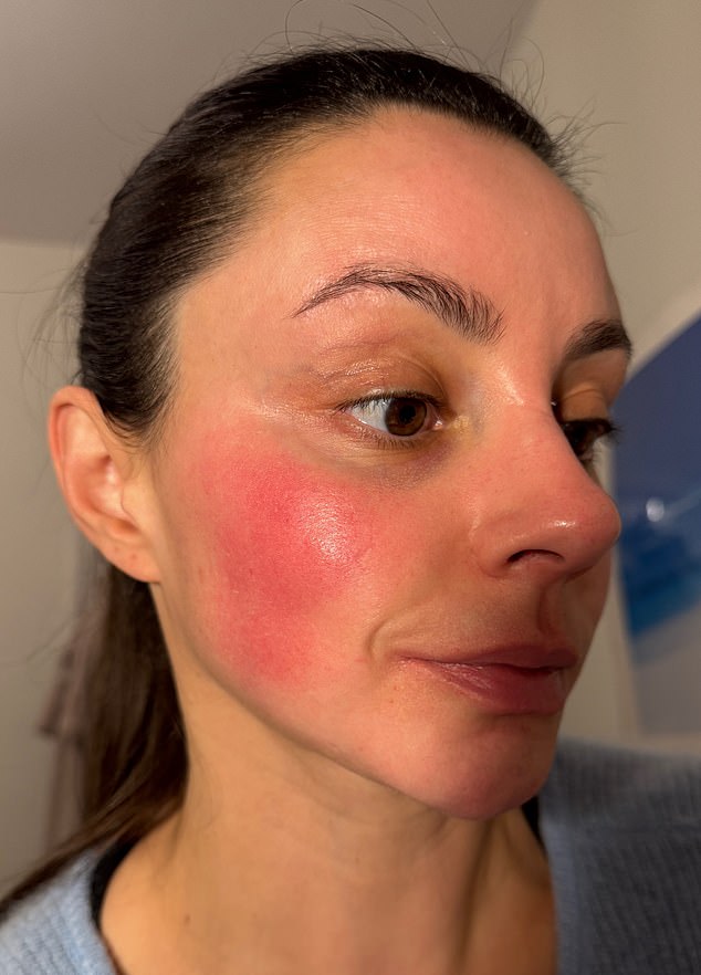 Emma shows off a patch of rosacea on her cheek before the treatment
