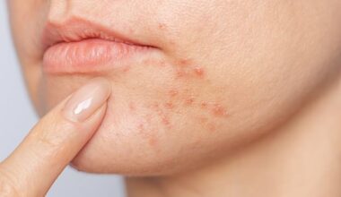 Azelaic acid is useful for everything from acne to rosacea, perioral dermatitis to hyperpigmentation