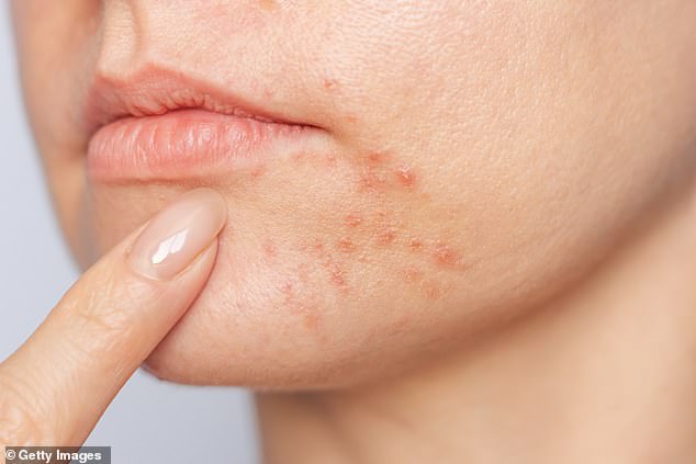 Azelaic acid is useful for everything from acne to rosacea, perioral dermatitis to hyperpigmentation