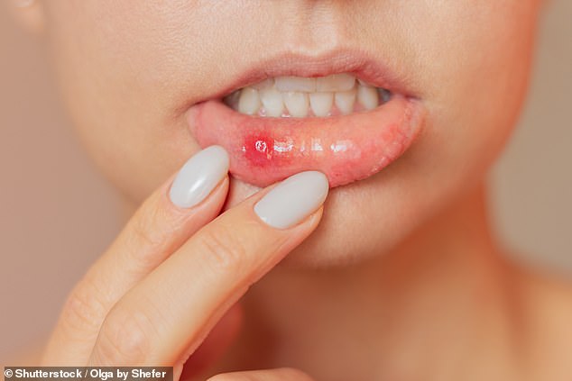 Mouth ulcers are breaks in the lining of the mouth, on the inner lips, inner cheeks or the tongue