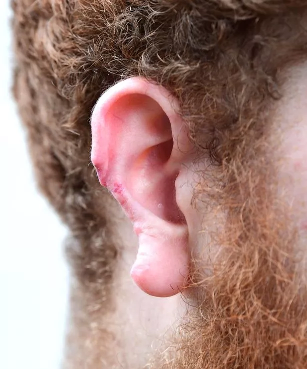 Kit Nolan-Barnes had his ear bitten off in 2023