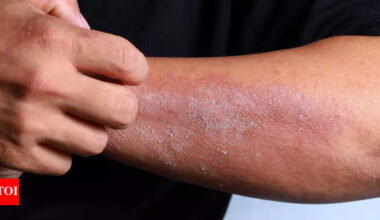 Itchy, dry skin on your hands, face, or knees? It could be eczema; know its causes, types, and symptoms |