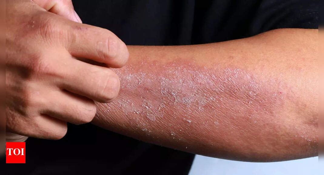 Itchy, dry skin on your hands, face, or knees? It could be eczema; know its causes, types, and symptoms |