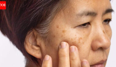 How Vitamin B12 deficiency shows up on your skin: Pigmentation, dryness, inflammation, and other warning signs |