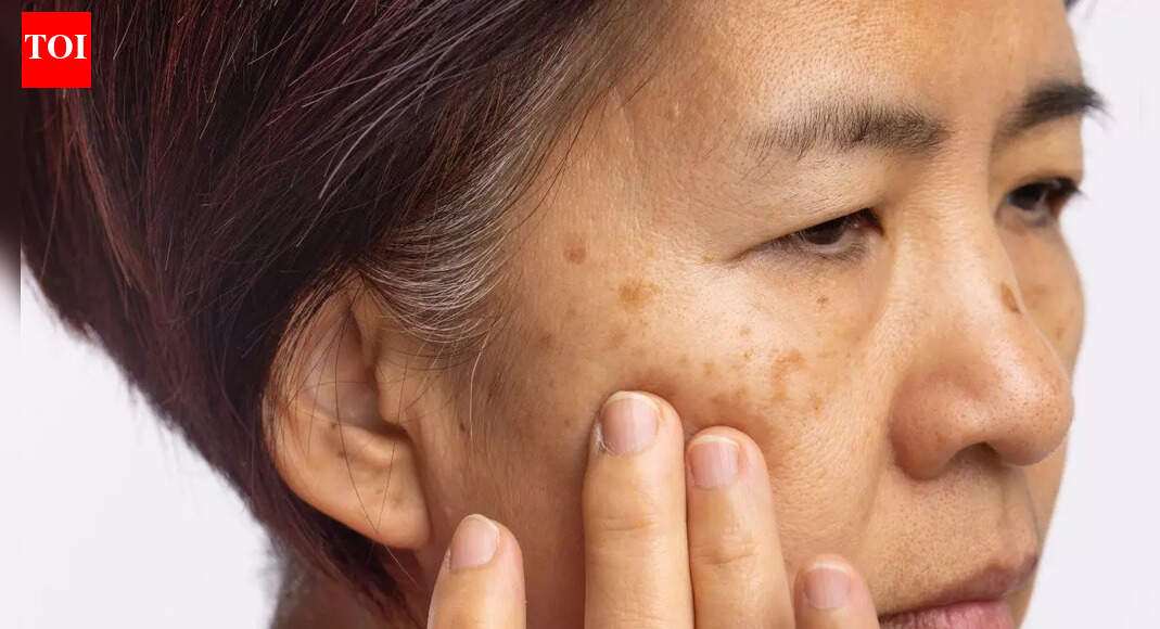 How Vitamin B12 deficiency shows up on your skin: Pigmentation, dryness, inflammation, and other warning signs |